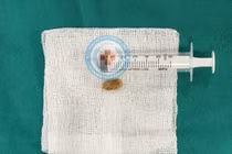 Cứu sống bé 10 tháng tuổi suy hô hấp do hóc dị vật 