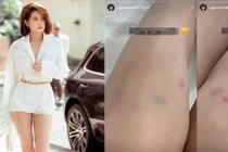 Ngắm chân thon “cực phẩm” của Ngọc Trinh trước khi lộ ảnh thâm tím đầu gối