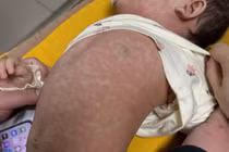 Nhiều bệnh nhi bị sởi biến chứng suy hô hấp cấp nặng