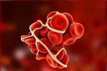 6 thói quen xấu làm tăng nguy cơ hình thành cục máu đông