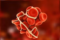 6 thói quen xấu làm tăng nguy cơ hình thành cục máu đông