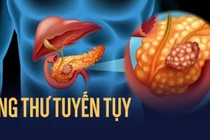 Cách phát hiện sớm ung thư tụy sâu trong ổ bụng