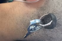 Nam học sinh bị chìa khóa cắm sâu vào đầu, chấn thương sọ não