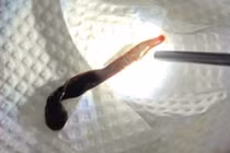 Gắp con vắt dài 8cm sống trong mũi người phụ nữ