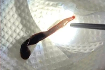 Gắp con vắt dài 8cm sống trong mũi người phụ nữ