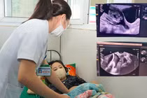 Cứu sống thai nhi 22 tuần nhờ thủ thuật khâu vòng tử cung