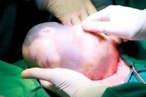 Hai bé song sinh chào đời, 1 bé còn nguyên trong “bọc điều” 