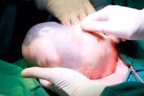 Hai bé song sinh chào đời, 1 bé còn nguyên trong “bọc điều” 
