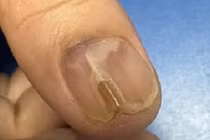 Đau sưng ngón tay suốt 7 năm, đi khám phát hiện u hiếm gặp