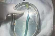 Người phụ nữ nuốt phải bàn chải đánh răng dài 20 cm vào bụng