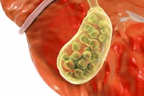 Cắt túi mật có ảnh hưởng đến sức khỏe?