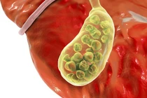 Cắt túi mật có ảnh hưởng đến sức khỏe?