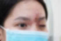 Cô gái trẻ mù mắt vì tiêm filler ở tiệm cắt tóc, gội đầu