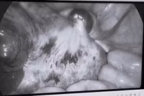 Bé gái 9 tuổi không ngờ mắc u buồng trứng xoắn hiếm gặp