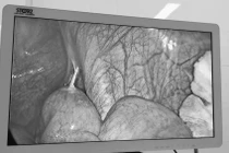 Bệnh nhân bị thủng ruột non do nuốt phải tăm tre