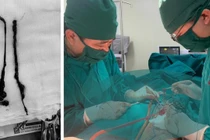 Đau chân, đi khám phát hiện tắc động mạch chậu đùi cấp