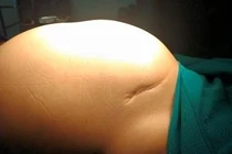 Người phụ nữ tưởng béo bụng không ngờ u buồng trứng gần 13 kg