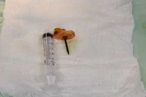 Phẫu thuật lấy chiếc đinh dài 4 cm ra khỏi hộp sọ bệnh nhân