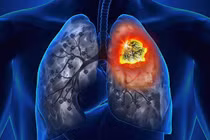 Thấy yếu nửa người, đi khám phát hiện ung thư phổi giai đoạn cuối