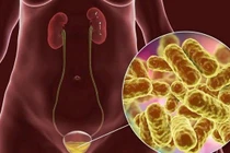 Bị viêm bàng quang có nên quan hệ tình dục?