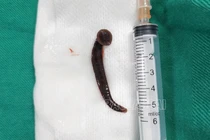 Đỉa sống dài hơn 5 cm nằm trong khí quản bệnh nhân 65 tuổi