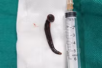 Đỉa sống dài hơn 5 cm nằm trong khí quản bệnh nhân 65 tuổi