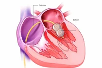 Cứu sống bé 9 ngày tuổi tím tái vì dị tật tim bẩm sinh