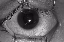 Nam thanh niên nhập viện với đoạn dây thép xuyên nhãn cầu