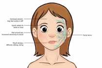 Bé 4 tuổi liệt dây thần kinh số 7 ngoại biên