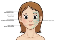 Bé 4 tuổi liệt dây thần kinh số 7 ngoại biên