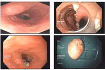 Cắt bỏ thành công u cơ thực quản đường miệng không cần phẫu thuật