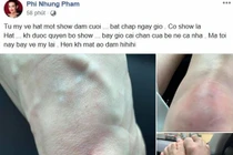 Phi Nhung bị ngã bầm tím chân vì vội vã chạy show