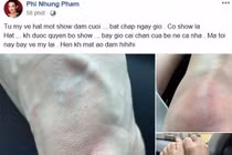 Phi Nhung bị ngã bầm tím chân vì vội vã chạy show