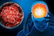 Sai lầm phổ biến khi xử trí đột quỵ gây nguy hiểm tính mạng