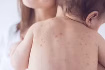 Cứu sống trẻ nhũ nhi sốt xuất huyết nặng