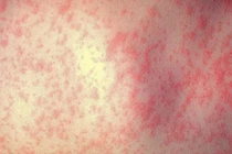 Nguyên nhân khiến dịch sởi bao trùm châu Âu