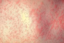 Nguyên nhân khiến dịch sởi bao trùm châu Âu