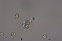 Bé 10 tháng tuổi bị Amip “ăn não”, tình trạng nguy kịch