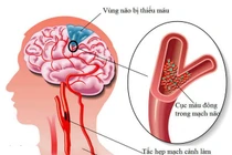 Dấu hiệu của thiếu máu não, đừng chủ quan đột quỵ như chơi