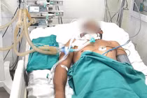 Ngã vào gốc cây mục, người đàn ông nguy kịch... vì uốn ván