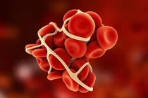 Những người dễ mắc chứng bệnh cục máu đông, phòng ngừa thế nào?