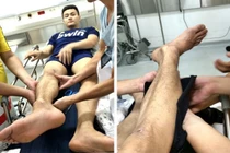 Siêu mẫu Vĩnh Thụy lên tiếng sau chấn thương nghiêm trọng