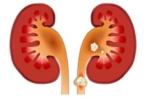 Người đàn ông bị sốc nhiễm khuẩn, thận ứ mủ do sỏi niệu quản