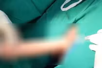 Dương vật giả 20cm mắc kẹt trong trực tràng nam thanh niên 23 tuổi