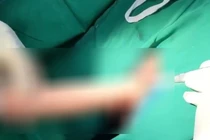 Dương vật giả 20cm mắc kẹt trong trực tràng nam thanh niên 23 tuổi