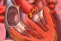 Mệt mỏi, sút cân, người đàn ông 47 tuổi phát hiện viêm nội tâm mạc