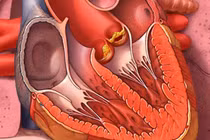 Mệt mỏi, sút cân, người đàn ông 47 tuổi phát hiện viêm nội tâm mạc