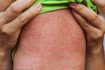 42 ca mắc Sởi tại 13 tỉnh, thành: Bộ Y tế chỉ đạo nóng