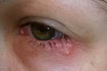 Nam thanh niên thấy mắt mờ... đi khám phát hiện mắc bệnh giang mai