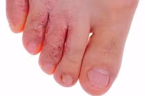 Thời tiết nồm ẩm, cẩn thận bệnh nấm da 